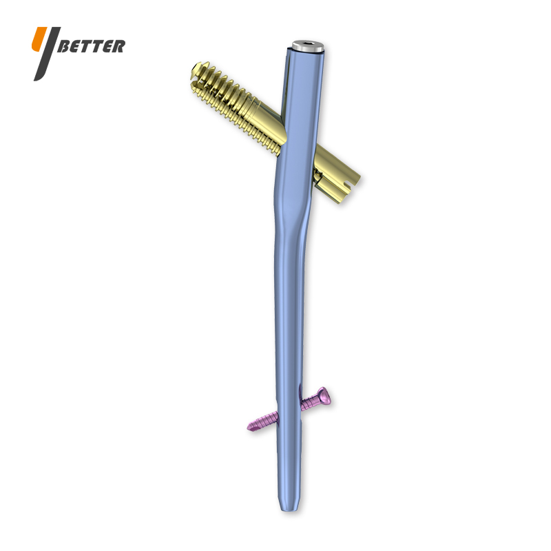 股骨近端可控加壓髓內釘